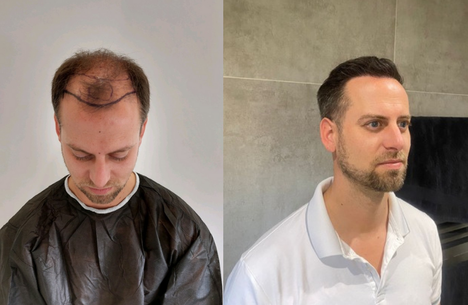 ervaringen-voor-en-na-foto Voor en na foto haartransplantatie man