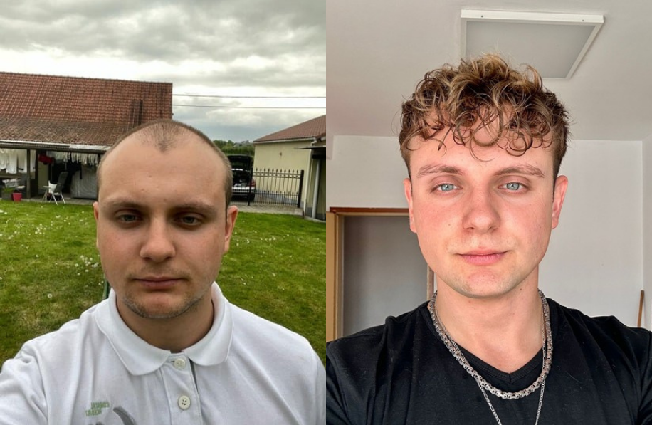 ervaringen-voor-en-na-foto Voor en na foto haartransplantatie man