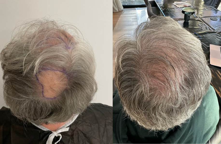 voor-en-na-foto-haartransplantatie Voor en na foto haartransplantatie man