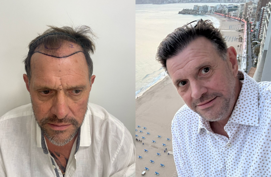 voor-en-na-foto-haartransplantatie Voor en na foto haartransplantatie man