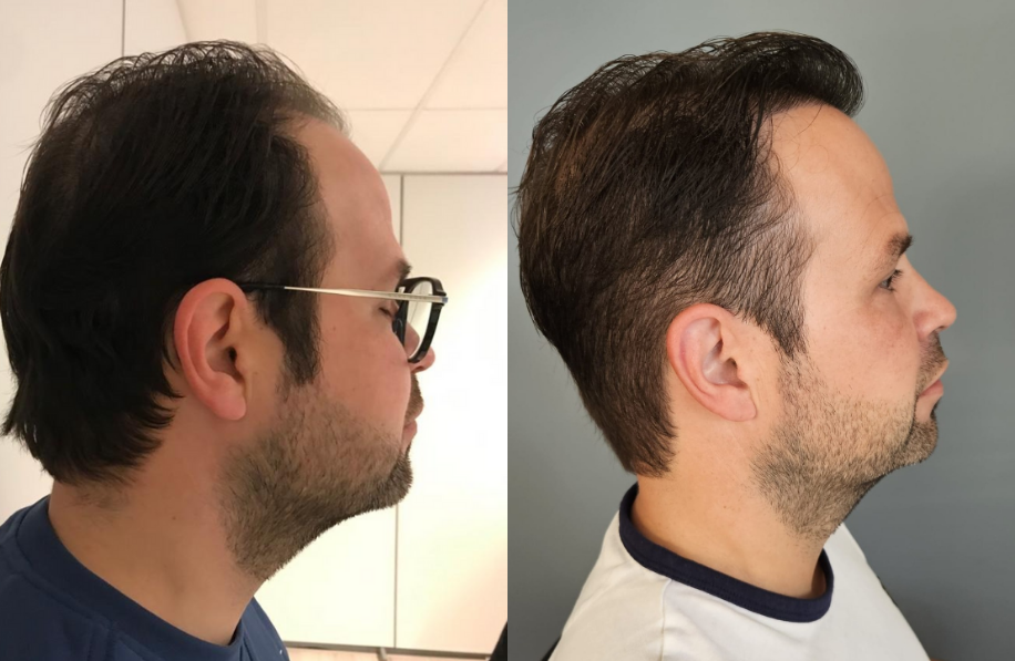 voor-en-na-foto-haartransplantatie Voor en na foto haartransplantatie man